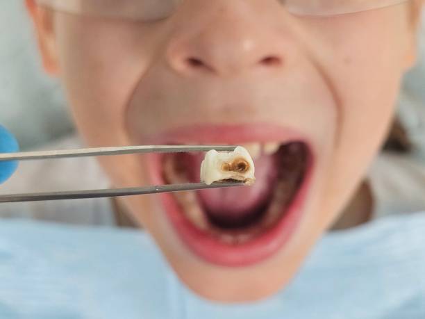 Best Emergency Treatment for Dental Infections or Abscesses in Vardaman, MS